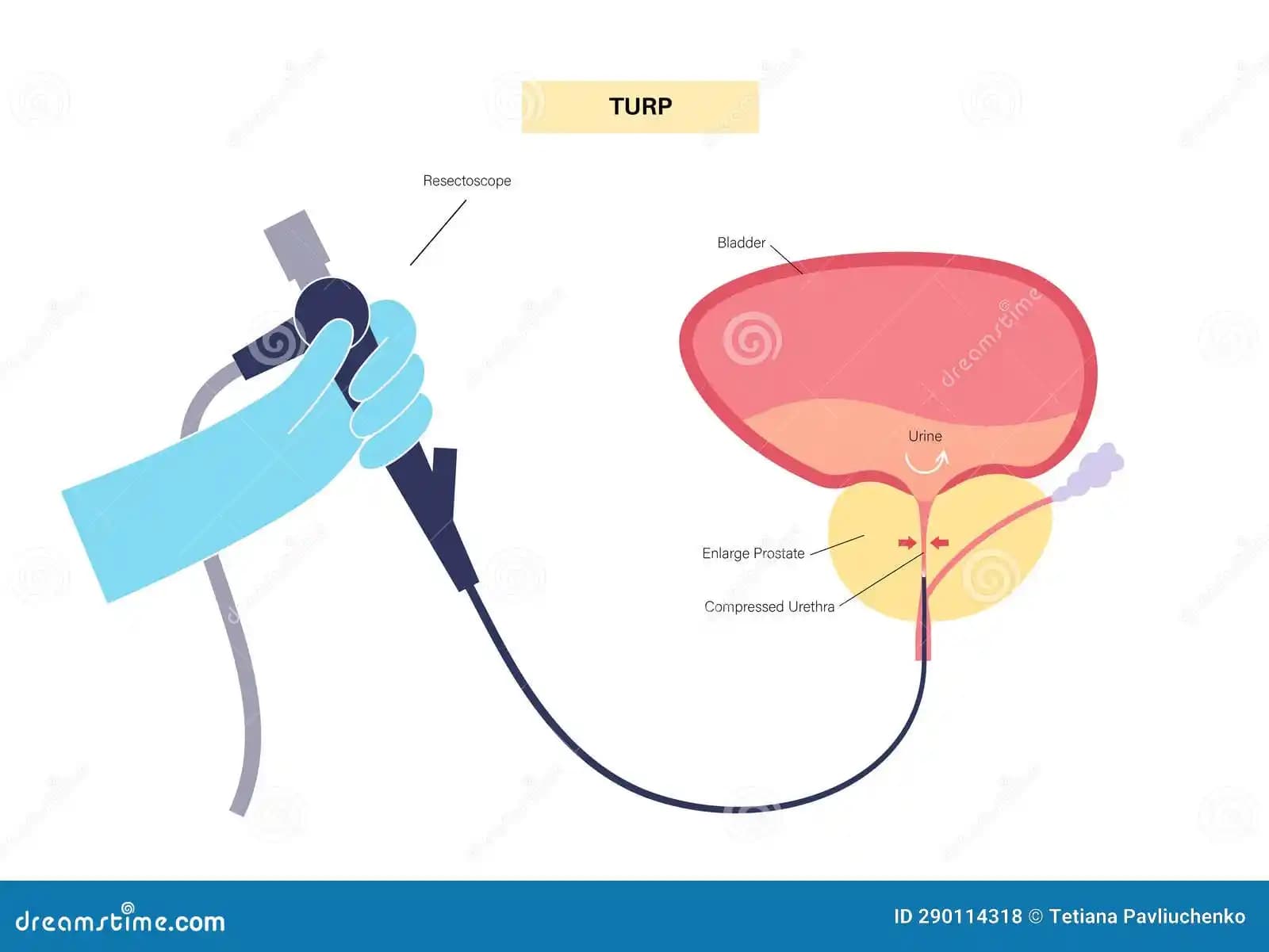 TURP (Transüretral Prostat Rezeksiyonu): Prostat Büyümesi Tedavisinde Güncel ve Etkili Yöntemler