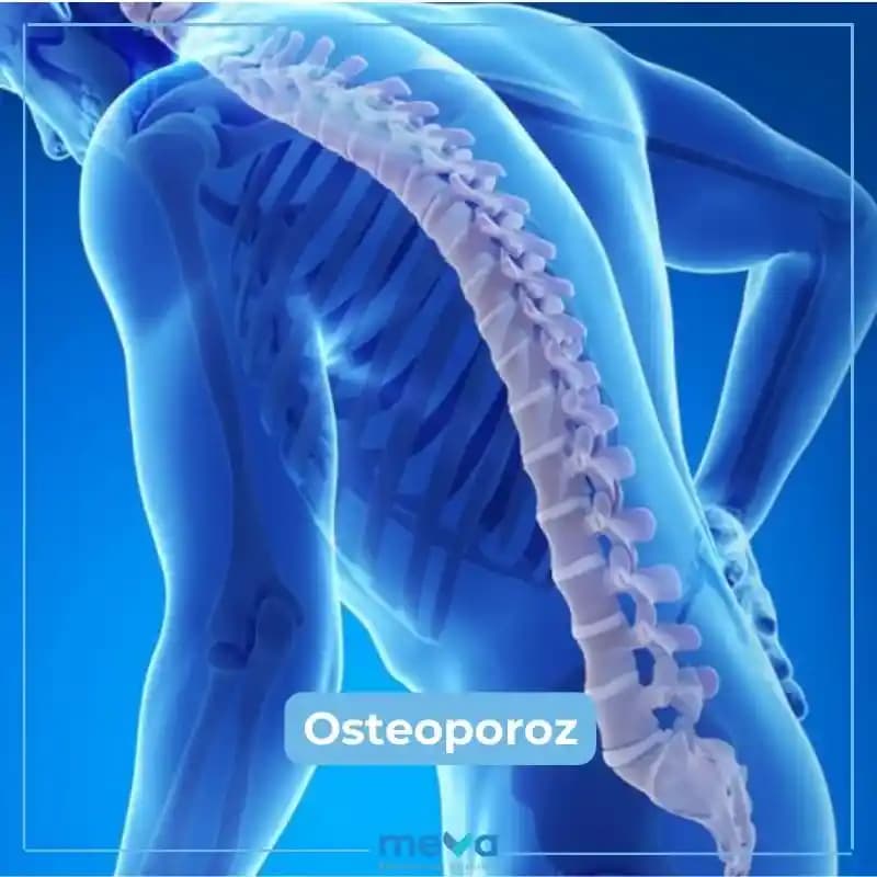 Osteoporoz İçin Kemik Güçlendiren Takviyeler ve Kemik Sağlığını Destekleyen En Etkili Yöntemler